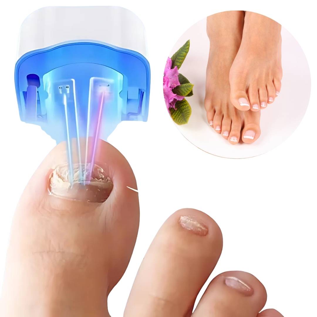 Tratamiento Láser Sin Dolor y Efectivo para Hongos en las Uñas